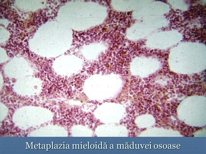 Metaplazia mieloidă a măduvei osoase